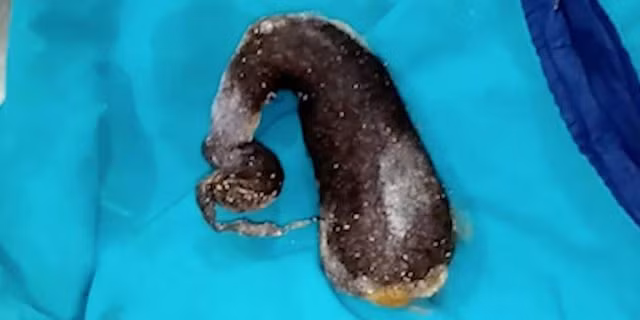 Búi tóc nặng hơn 1,3kg trong bụng bé gái.