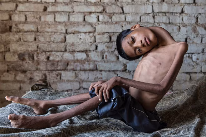 Mahendra phải nhìn thế giới lộn ngược trong suốt 13 năm. Ảnh: Mirror.