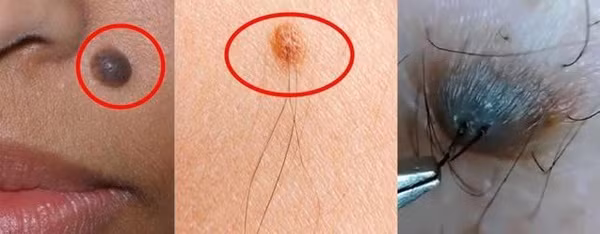 Cần đi khám để bác sĩ chẩn đoán khi nghi ngờ nốt ruồi bị ung thư. Ảnh: MNS.