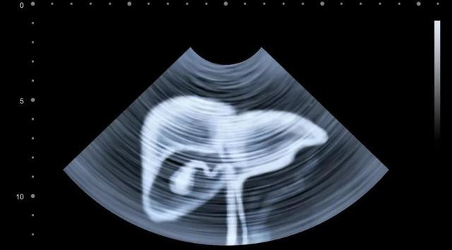 5 nhóm người rất dễ bị bệnh ung thư gan tấn công: Khi phát hiện bệnh thường đã quá muộn - Ảnh 5. 5 nhóm người rất dễ bị bệnh ung thư gan tấn công: Khi phát hiện bệnh thường đã quá muộn-5