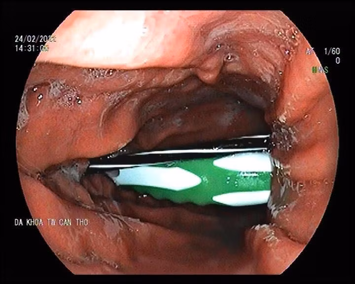 Hình ảnh thân bàn chải lúc nội soi.