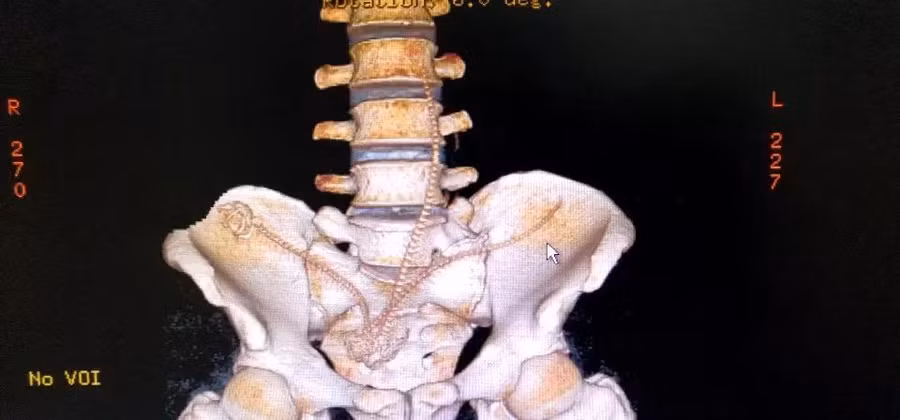 Bác sĩ bất ngờ vì người đàn ông tự nhét 3 con cá vào hậu môn