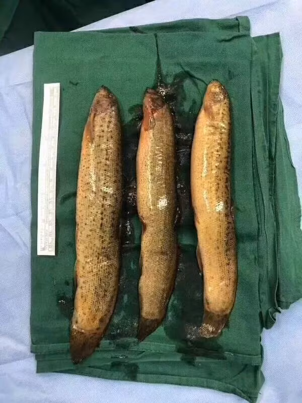 Bác sĩ bất ngờ vì người đàn ông tự nhét 3 con cá vào hậu môn