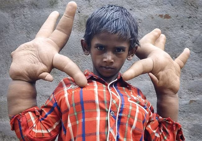 nhung chung benh hiem gap nhat tren the gioi hinh anh 10