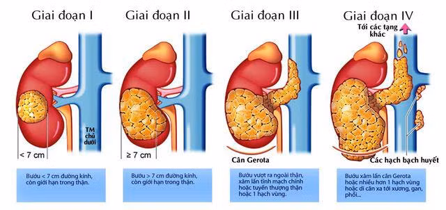 Cậu bé bị ung thư thận vì cả ngày chỉ ăn một món được khuyến cáo không ăn quá nhiều-2