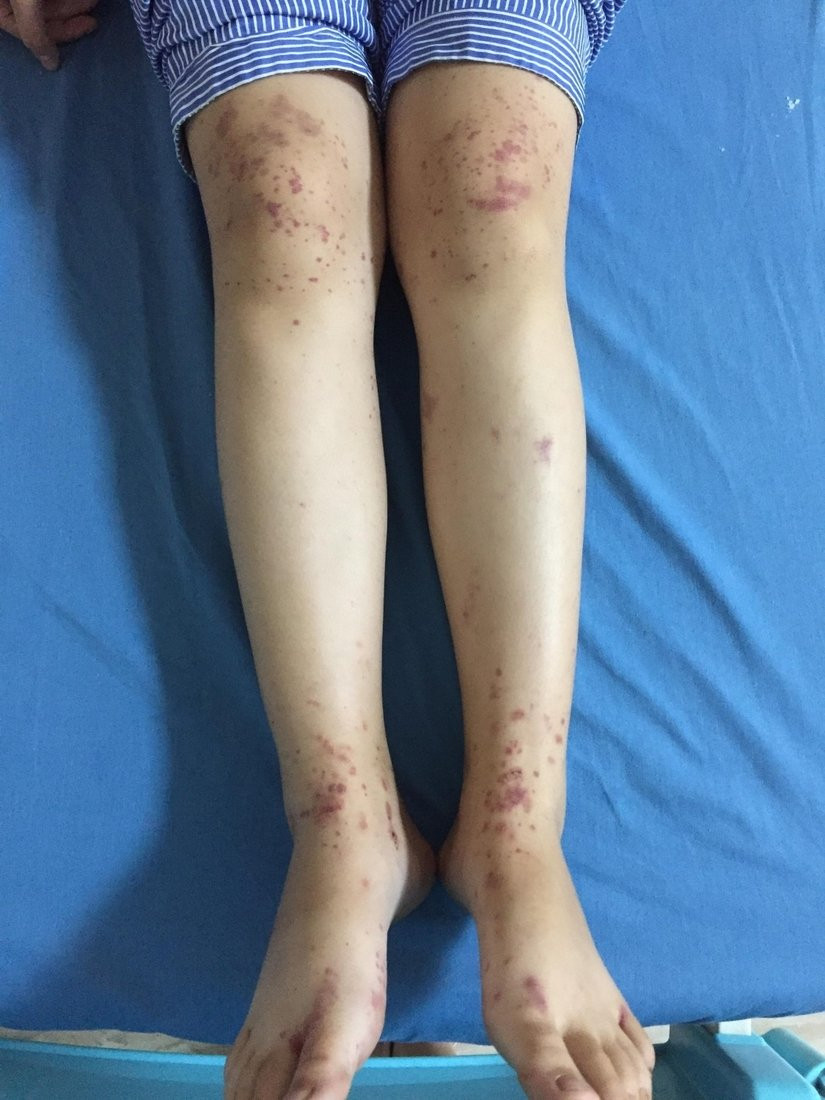 Trẻ nổi nốt đỏ trên người, tưởng muỗi đốt thông thường không ngờ mắc bệnh nguy hiểm