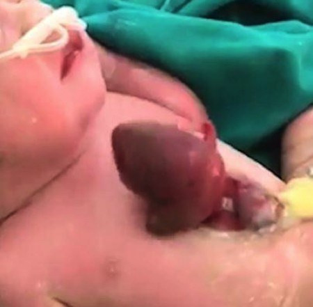 Sửng sốt bé sơ sinh có trái tim đập ngoài lồng ngực