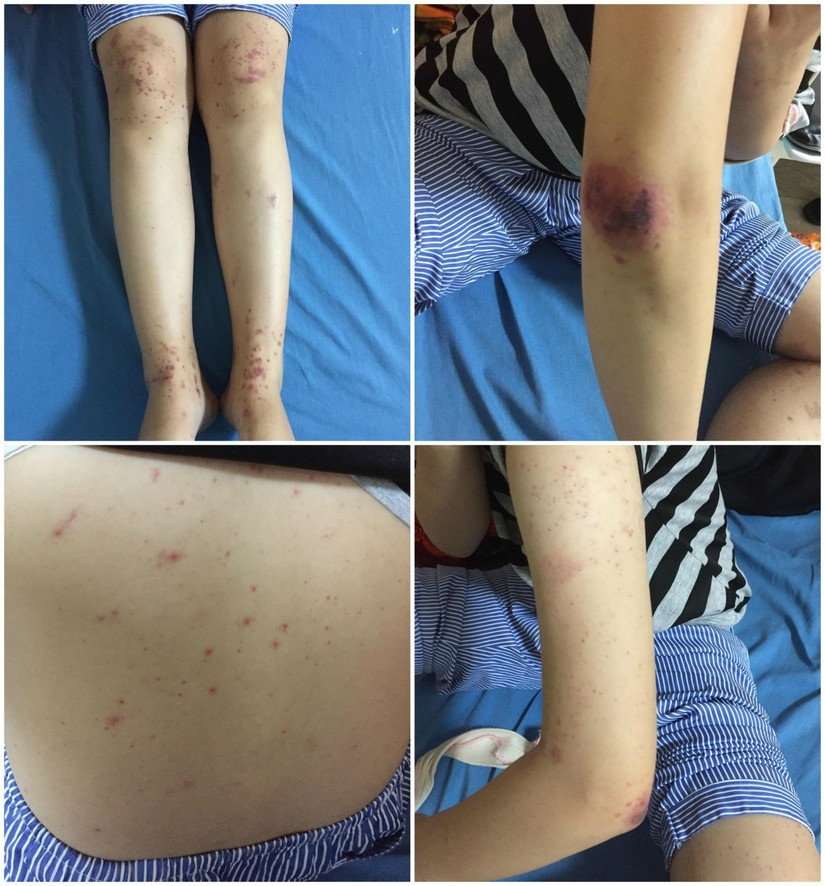Trẻ nổi nốt đỏ trên người, tưởng muỗi đốt thông thường không ngờ mắc bệnh nguy hiểm