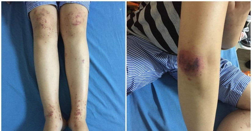 Trẻ nổi nốt đỏ tưởng muỗi đốt thông thường, không ngờ mắc bệnh nguy hiểm