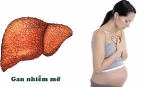 Gan nhiễm mỡ cấp khi mang thai, chữa thế nào?