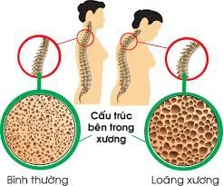 Canxi, vitamin D và tập luyện làm giảm nguy cơ loãng xương