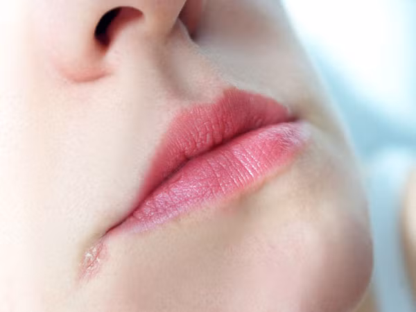 Làm gì khi bị chốc mép?