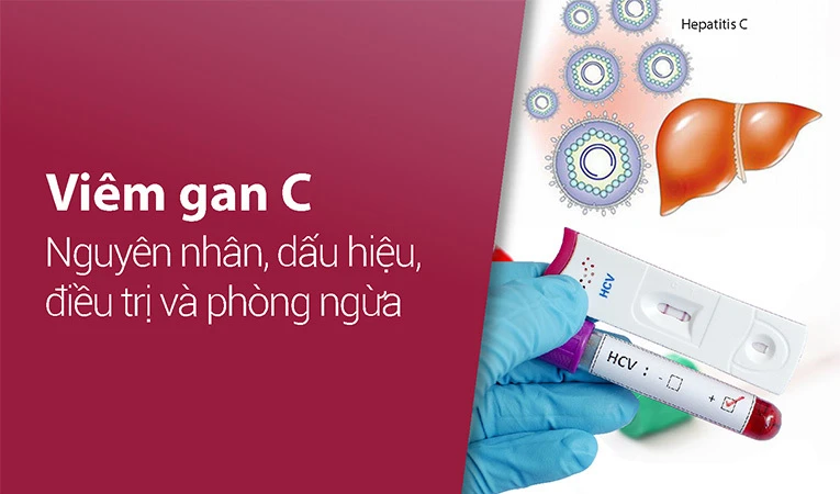 Viêm gan C dễ dẫn đến viêm gan mạn tính, xơ gan và ung thư gan 