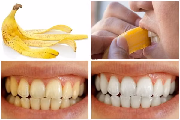 Chọn vỏ chuối chín để làm trắng răng