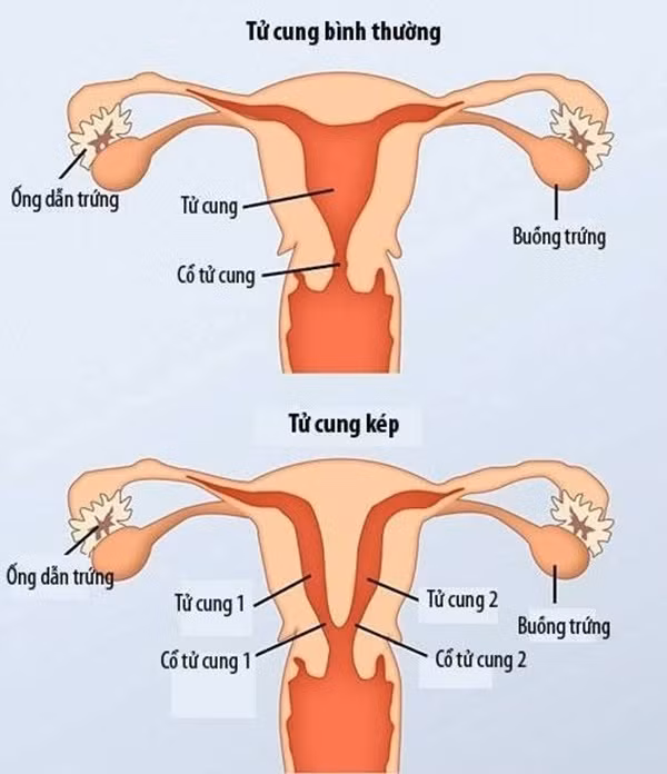 Đau đớn suốt 10 năm, cô gái được phát hiện có 2 tử cung, 2 âm đạo-3