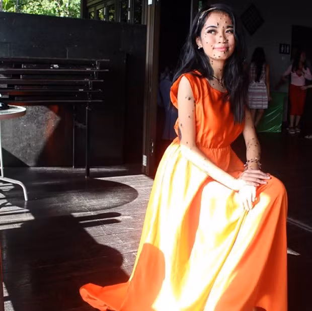 Cô gái có làn da chấm bi nốt ruồi làm thay đổi chuẩn mực cái đẹp - Ảnh 3.