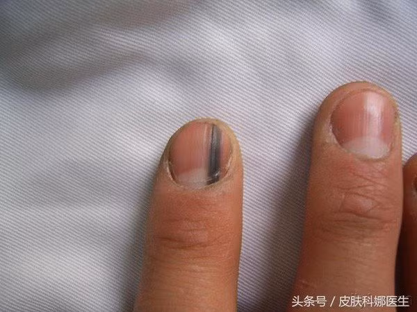 Những dấu hiệu ở móng tay cảnh báo bạn mắc bệnh nặng, có cả ung thư