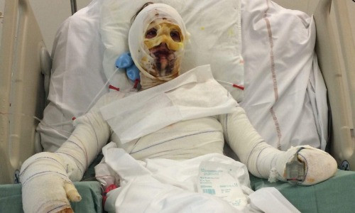 Lagier băng bó khắp người do dị ứng với penicillin. Ảnh: MDW.