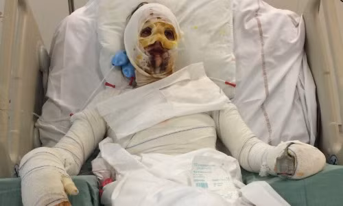 Lagier băng bó khắp người do dị ứng với penicillin. Ảnh: MDW.