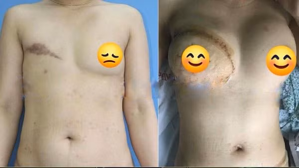 Người phụ nữ nhiều năm phải nhét giẻ vào ngực vì lý do đau đớn