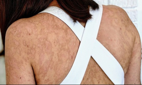 Vùng da lưng hiện tại của Lagier. Ảnh: MDW.