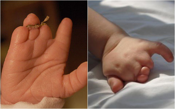 Mẹ lặng người khi sinh con ra không có bàn tay, bác sĩ mổ tìm thấy 1 bàn tay bé xíu còn nằm trong tử cung - Ảnh 5. Mẹ lặng người khi sinh con ra không có bàn tay, bác sĩ mổ tìm thấy 1 bàn tay bé xíu còn nằm trong tử cung - Ảnh 5.
