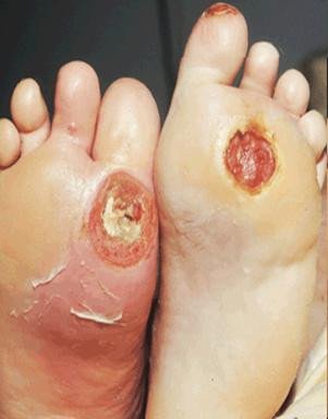 Cần phát hiện sớm bệnh tiểu đường và kiểm soát tốt đường huyết để phòng ngừa nguy cơ biến chứng Cần phát hiện sớm bệnh tiểu đường và kiểm soát tốt đường huyết để phòng ngừa nguy cơ biến chứng