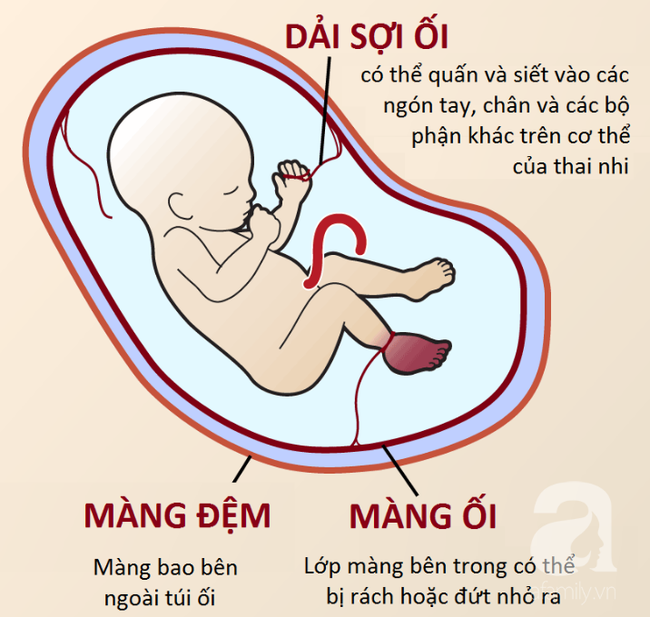 Mẹ lặng người khi sinh con ra không có bàn tay, bác sĩ mổ tìm thấy 1 bàn tay bé xíu còn nằm trong tử cung - Ảnh 4. Mẹ lặng người khi sinh con ra không có bàn tay, bác sĩ mổ tìm thấy 1 bàn tay bé xíu còn nằm trong tử cung - Ảnh 4.
