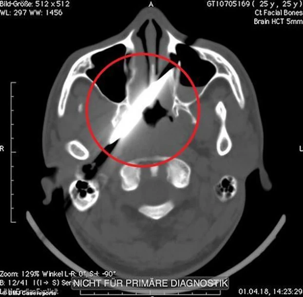 Người đàn ông bị lưỡi dao dài 10cm ghim trong đầu 4 ngày mà không biết