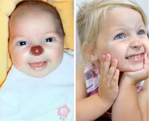 Vết bớt trên cơ thể con người và những điều không phải ai cũng biết - Ảnh 3.