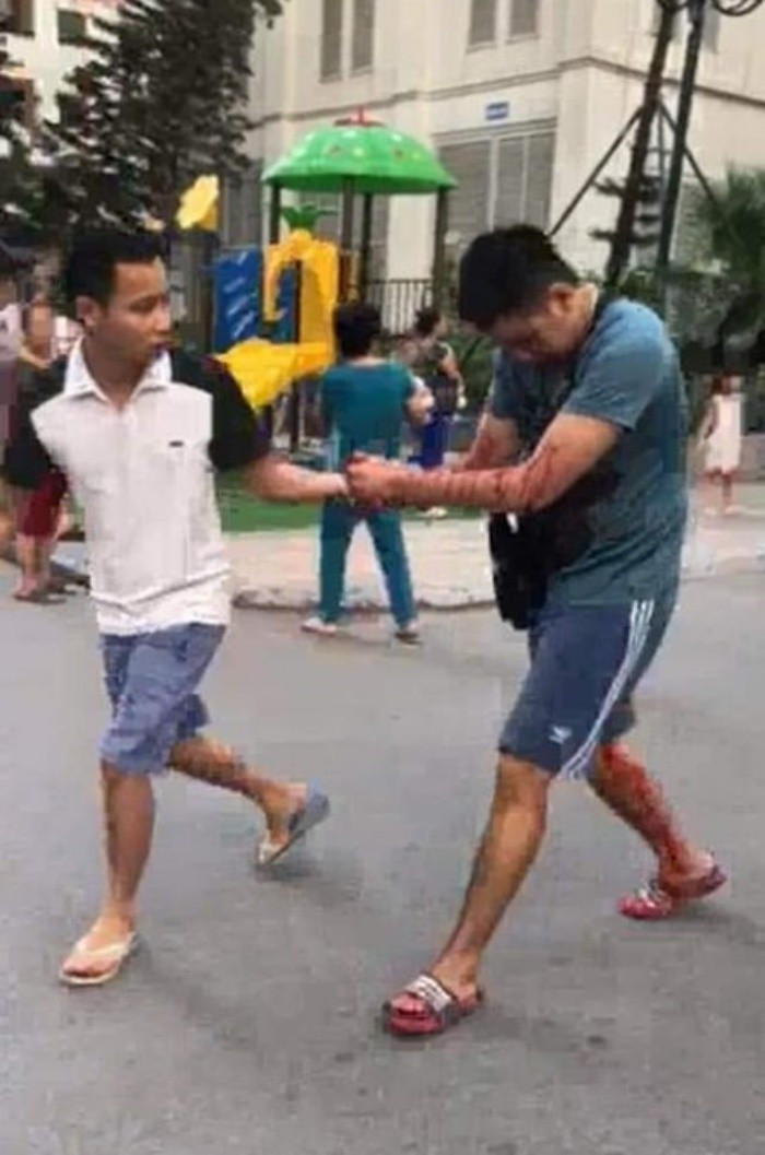 Lời khai nghi phạm gửi hộp bưu phẩm phát nổ ở chung cư Linh Đàm ảnh 2 Nam thanh niên bị thương nặng ở tay sau vụ nổ.