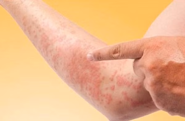 Để chống chọi với những cơn dị ứng vào mùa thu