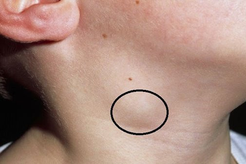 Đừng thấy mụn mà bôi thuốc liên tục, cẩn thận đang mắc UNG THƯ mà không hay biết ảnh 1 munblogtamsuvn1