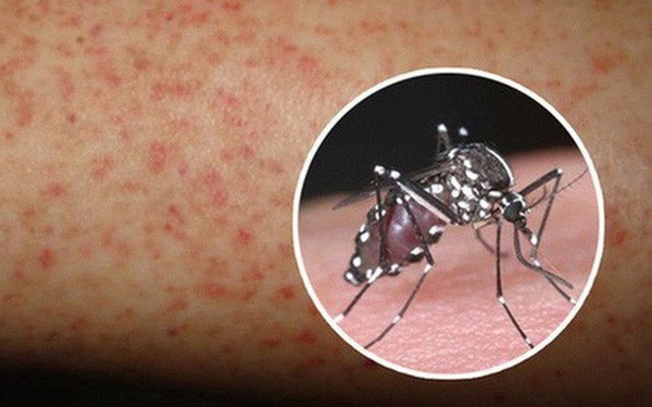 Chỉ cần 1 người trong nhà bị sốt xuất huyết, thực hiện ngay 4 biện pháp sau để không ai bị lây bệnh-4