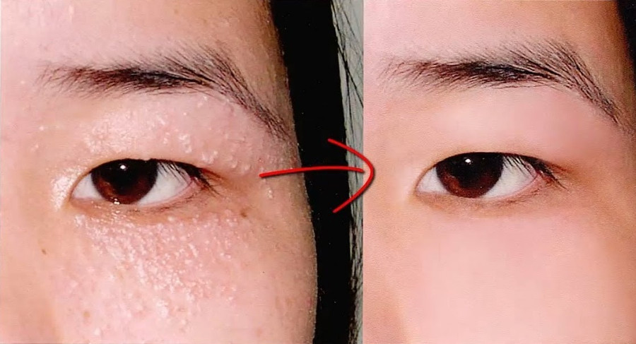 Chỉ cần 1 nắm lá tía tô làm theo cách này, mụn thịt quanh mắt sẽ biến mất ảnh 2 Chỉ cần 1 nắm lá tía tô làm theo cách này, mụn thịt quanh mắt sẽ biến mất ảnh 2