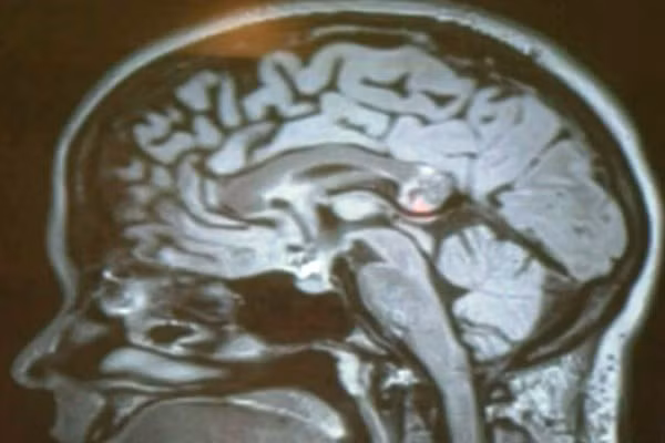 Kinh ngạc phôi thai trong… não người