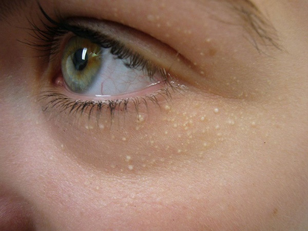 Chỉ cần 1 nắm lá tía tô làm theo cách này, mụn thịt quanh mắt sẽ biến mất ảnh 1 Chỉ cần 1 nắm lá tía tô làm theo cách này, mụn thịt quanh mắt sẽ biến mất ảnh 1