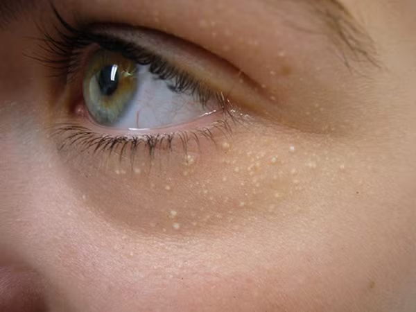 Chỉ cần 1 nắm lá tía tô làm theo cách này, mụn thịt quanh mắt sẽ biến mất ảnh 1