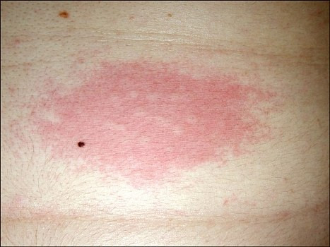 Biểu hiện của chứng dị ứng nước aquagenic urticaria (NIH.gov). Biểu hiện của chứng dị ứng nước aquagenic urticaria (NIH.gov).