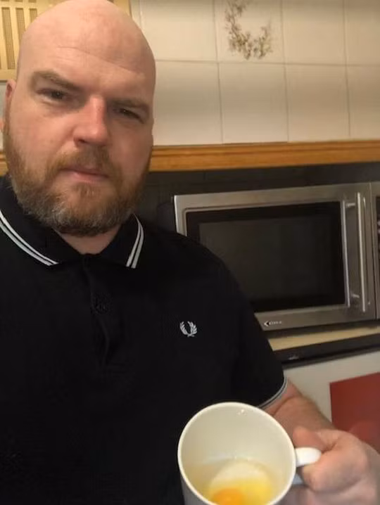 Người đàn ông bị tróc cả mảng da mặt vì nấu trứng bằng lò vi sóng 2