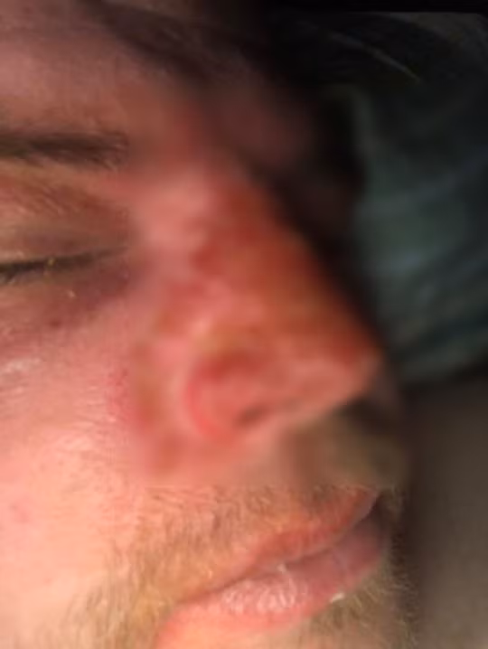 Người đàn ông bị tróc cả mảng da mặt vì nấu trứng bằng lò vi sóng 1