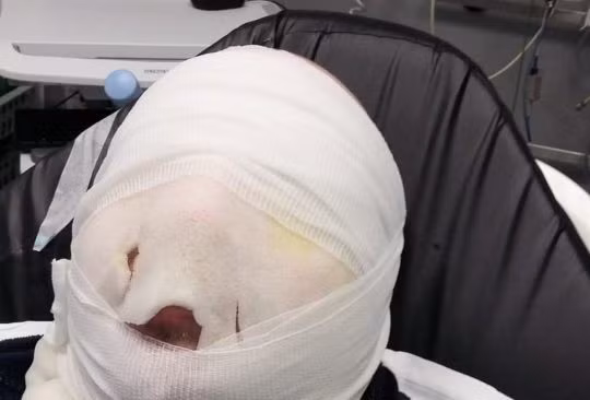 Nấu thứ này bằng lò vi sóng, người đàn ông “bay” cả mảng da mặt 