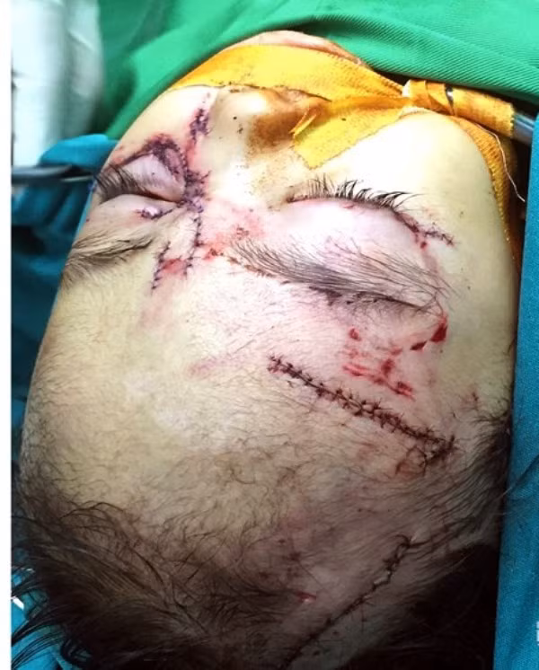 Cháu T.T.H.Y (31 tháng tuổi, trú ở xã Nam Sơn, huyện Đô Lương, Nghệ An) trong tình trạng bị nhiều vết thương ở vùng mặt do bị chó nhà cắn Cháu T.T.H.Y (31 tháng tuổi, trú ở xã Nam Sơn, huyện Đô Lương, Nghệ An) trong tình trạng bị nhiều vết thương ở vùng mặt do bị chó nhà cắn