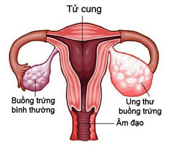 Ung thư buồng trứng xuất phát từ nhiều nguyên nhân, trong đó có nguyên nhân liên quan đến yếu tố di truyền.