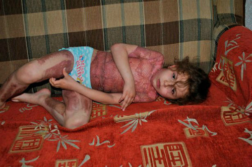 Sofia Ezhova bỏng nặng sau khi làm theo lời hướng dẫn "trở thành nàng tiên" của trò chơi trên mạng - Ảnh:The Sun be-5-tuoi-bi-bong-nang-vi-tro-lua-dao-tren-mang