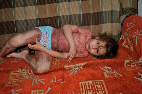 be-5-tuoi-bi-bong-nang-vi-tro-lua-dao-tren-mang