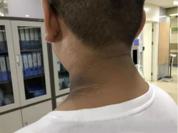 Đưa con đi khám vì “vết bẩn” trên cổ, kết quả khiến mẹ sững sờ ảnh 1 dua con di kham vi "vet ban” tren co, ket qua khien me sung so con ba thi hoi han - 3