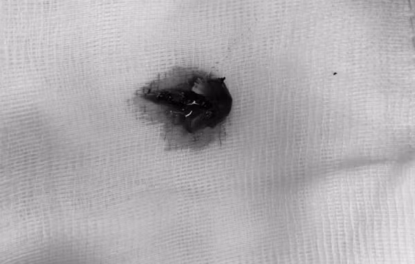 Dị vật được lấy ra khỏi phổi bệnh nhân. Ảnh bệnh viện cung cấp.