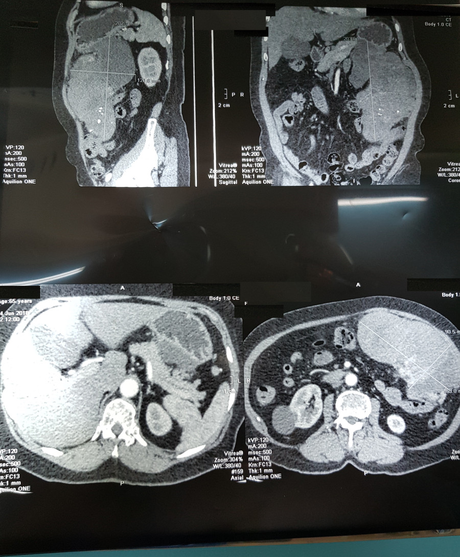 CT- scan hình ảnh khối u “ khổng lồ” trong ổ bụng của bệnh nhân CT- scan hình ảnh khối u “ khổng lồ” trong ổ bụng của bệnh nhân