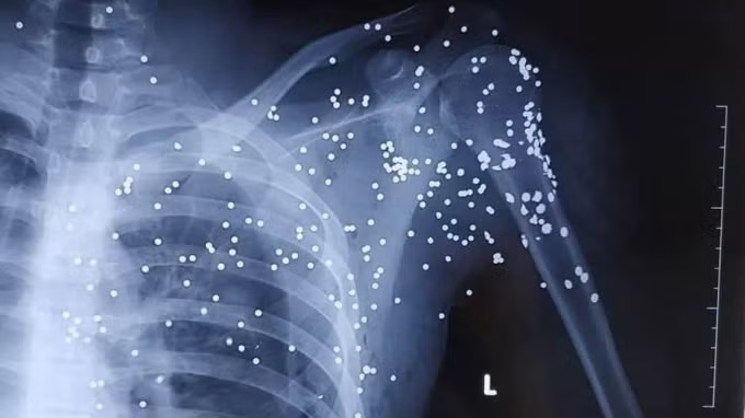 Hình chụp X-Quang cho thấy đạn găm vào vùng phổi của nạn nhân.
